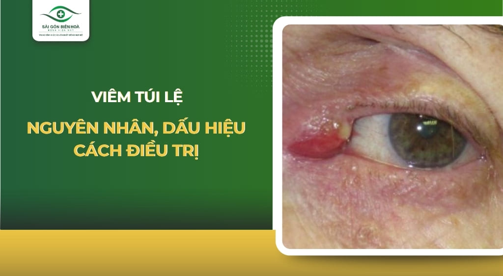 viêm túi lệ