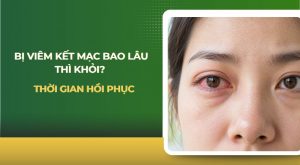 Bị viêm kết mạc bao lâu thì khỏi