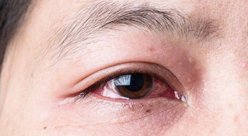 Dị ứng là một trong các nguyên nhân gây viêm kết mạc và phụ thuộc vào mức độ tiếp xúc với dị nguyên
