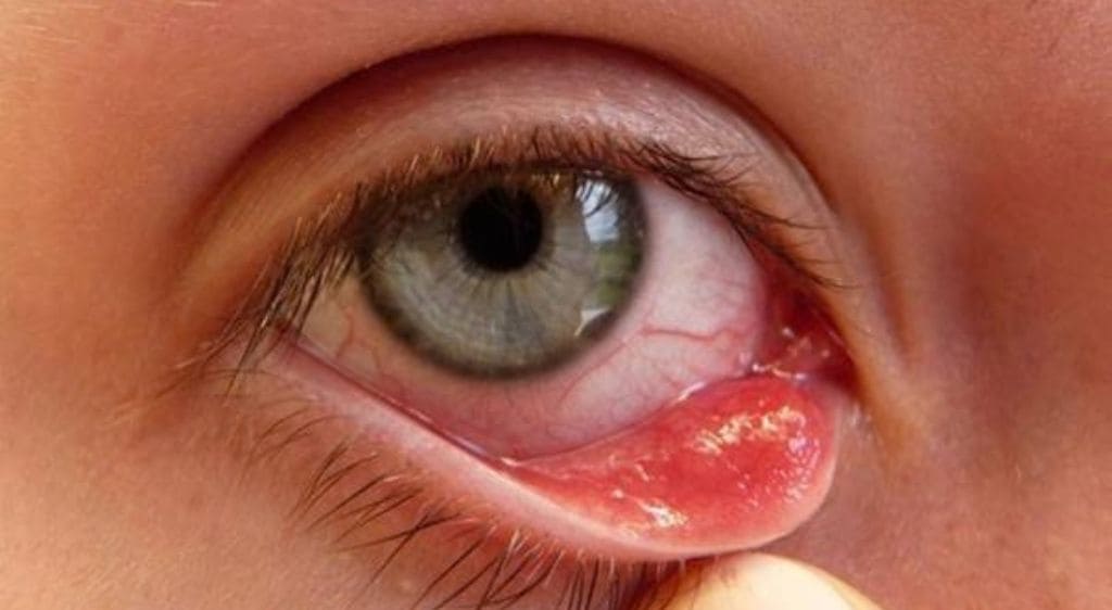 Một số bệnh lý khác như viêm bờ mi, rối loạn tuyến Meibomius, khô mắt,... có thể làm tăng nguy cơ biến chứng