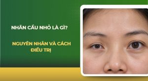 Nhãn cầu nhỏ
