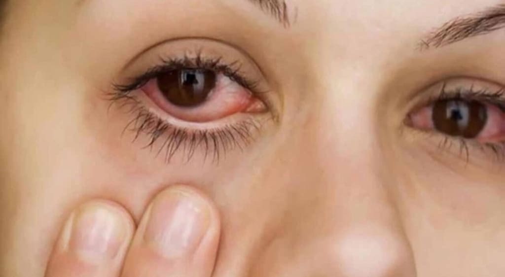 Nhãn cầu nhỏ có thể được phát hiện sau sinh với biểu hiện khác nhau tùy mức độ.