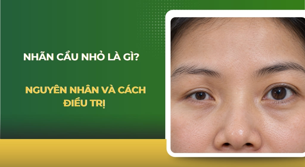 Nhãn cầu nhỏ
