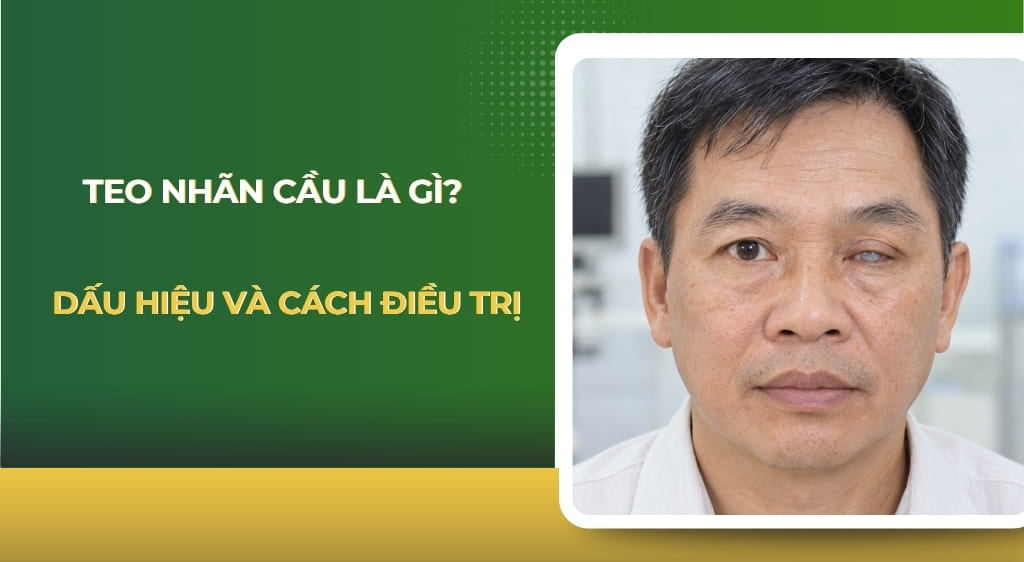 Teo nhãn cầu