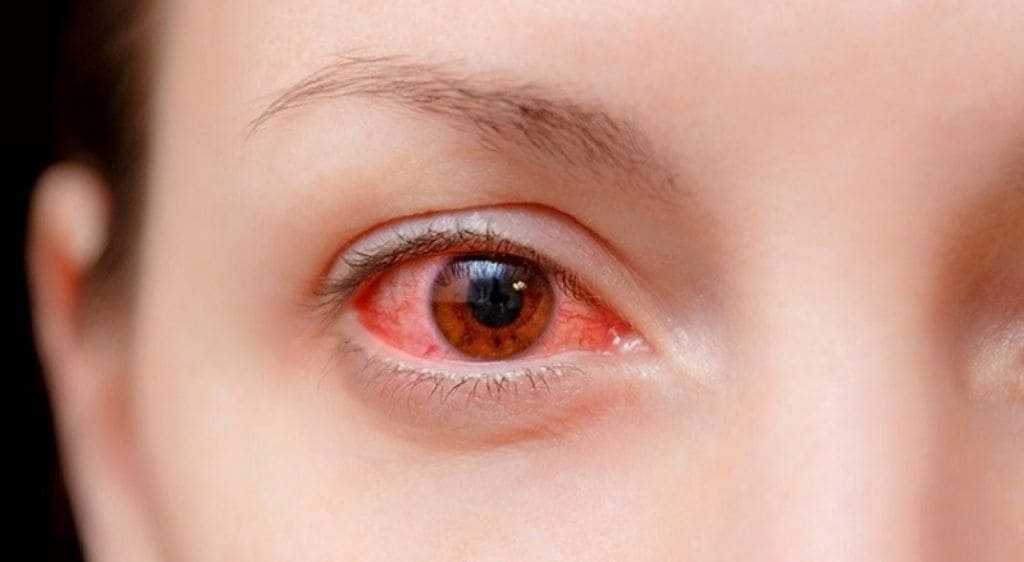 Viêm kết mạc cấp là tình trạng lớp màng trong suốt bao phủ lòng trắng nhãn cầu bị viêm sưng đỏ đột ngột