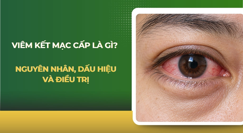 Viêm kết mạc cấp