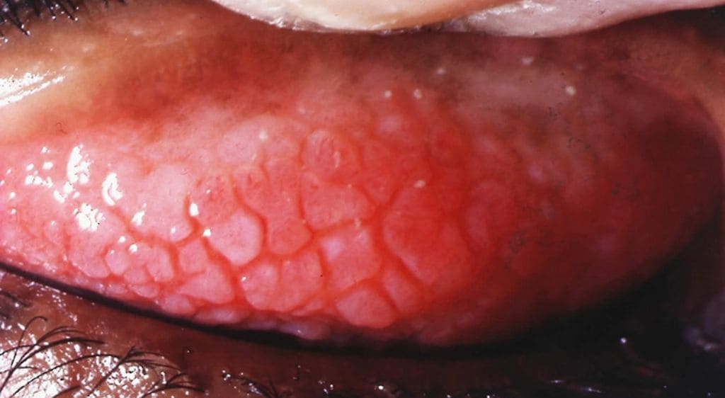 Viêm kết mạc dị ứng kéo dài có thể khiến bệnh kéo dài và lâu khỏi hơn