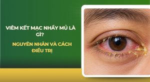 Viêm kết mạc nhầy mủ