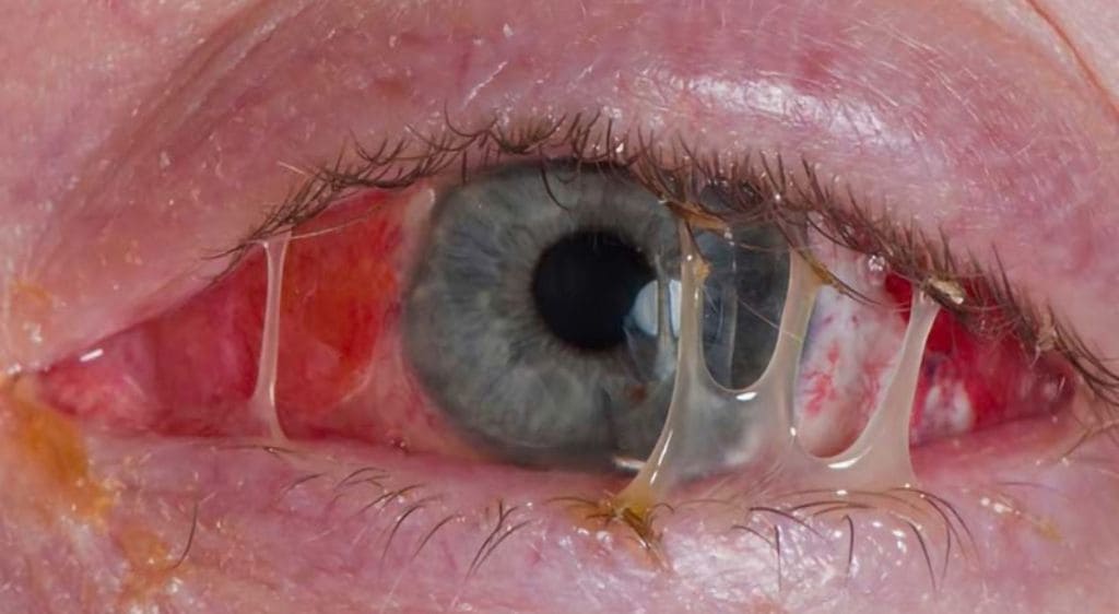 Viêm kết mạc nhầy mủ là tình trạng kết mạc bị viêm kèm theo dịch tiết có tính chất vừa nhầy vừa giống mủ