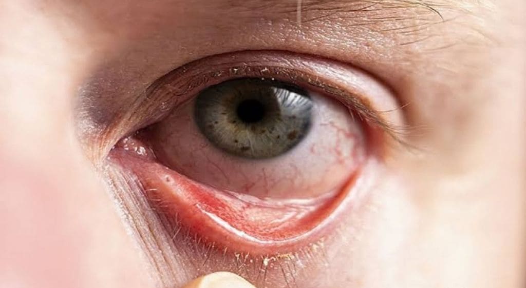 Viêm kết mạc xảy ra khi lớp kết mạc mắt bị viêm nhiễm hoặc kích ứng, khiến các mạch máu giãn nở và làm mắt chuyển sang màu đò
