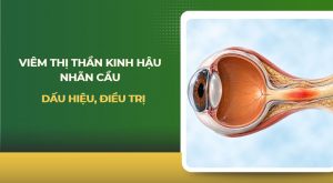 Viêm thị thần kinh hậu nhãn cầu
