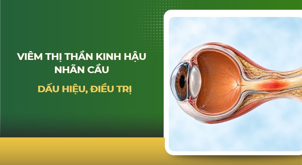 Viêm thị thần kinh hậu nhãn cầu